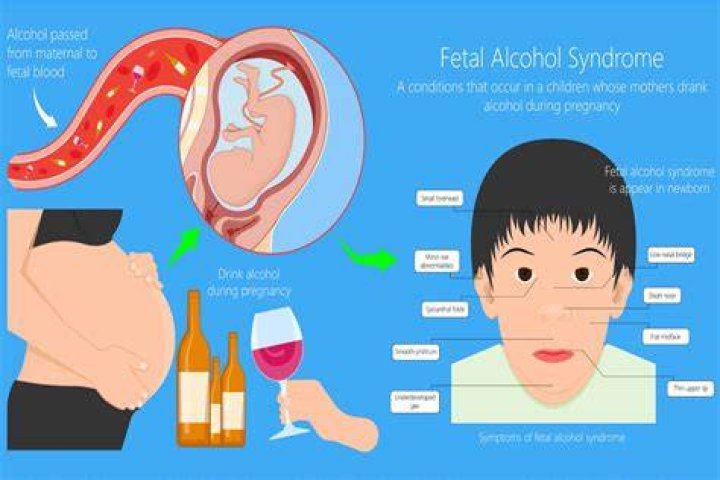 Uncovering The Truths And Impacts Of Fetal Alcohol Syndrome